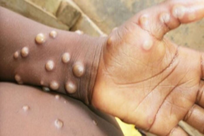 49 new cases of mpox reported in Uganda
